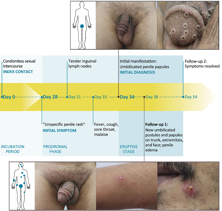 Clinical features and chronology of events in an instructive case from clade IIb–associated reemergence of mpox in Germany, July–December 2023.