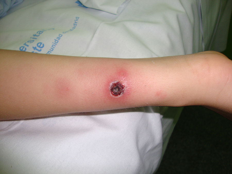 Eschar from Rickettsia sibirica mongolitimonae infection located on upper limb of a pediatric patient in Spain. 