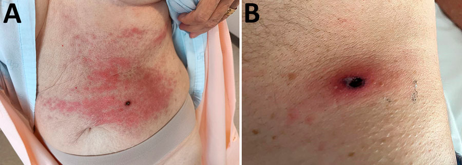 Eschars from Rickettsia sibirica mongolitimonae infections of 2 patients in Spain, located on the abdomen of 1 patient (A) and on the iliac fossa of another patient (B). 