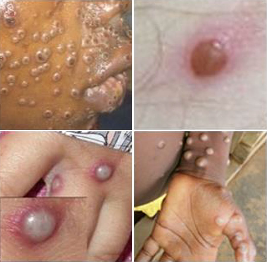 Examples of pustular eruptions from monkeypox virus. Image source: Centers for Disease Control and Prevention (https://www.cdc.gov/mpox/hcp/clinical-signs).