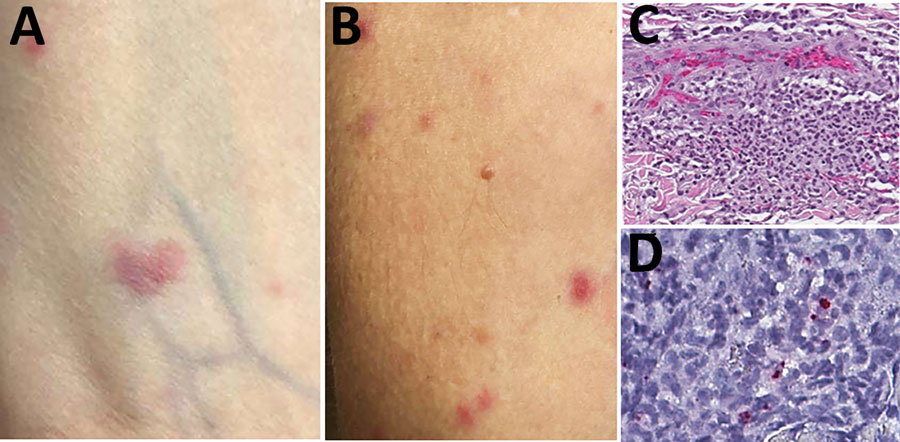 Skin lesions and testing results for a kidney transplant receipient diagnosed with Rickettsia parkeri rickettsiosis, North Carolina, USA, 2023. A, B) Sparse maculopapular rash involving forearms. Lesions ranged from 0.2 to 3 cm in greatest dimension and were tender and erythematous. C) Histopathologic appearance of rash lesion demonstrating periscular collections of mixed inflammatory cell infiltrates in the mid-dermis comprising predominantly neutrophils and macrophages. Hematoxylin and eosin stain; original magnification ×50. D) Immunohistochemical detection of antigens of Rickettsia parkeri (red) in dermal inflammatory cell infiltrates. Immunoalkaline phosphatase with naphthol-fast red and hematoxylin counterstain; original magnification ×100.