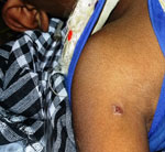 An eschar in the axillary area in the stage of healing in a patient with diagnosed scrub typhus.