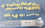 Proglottids of Taenia solium collected from a patient in Dili, Timor-Leste, in case study of molecular confirmation of taeniasis in a child. We collected the expelled worm segments from a 10-year-old girl on the same day she was treated with 10 mg/kg praziquantel.