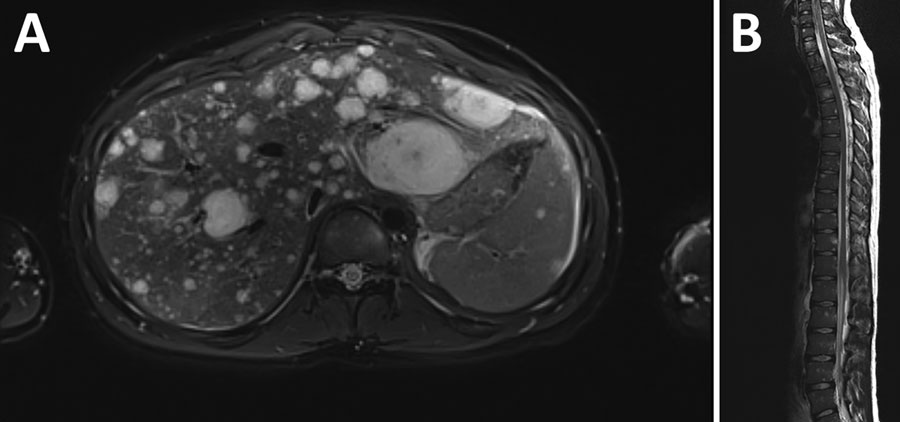 Imaging of a kidney transplant recipient with a Bartonella quintana infection linked to a donor who experienced homelessness, United States, 2022. A) Multiple enhancing T2 hyperintense lesions throughout the hepatic parenchyma. B) Numerous enhancing T2 hyperintense lesions affecting cervical, thoracic, and lumbar vertebrae.