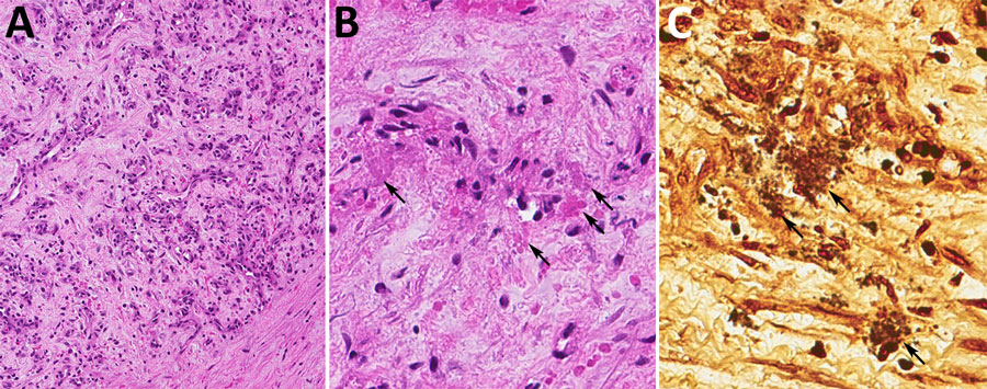 Liver biopsy of a kidney transplant recipient with a Bartonella quintana infection linked to a donor who experienced homelessness, United States, 2022. A) Fibrovascular proliferation accompanied by few inflammatory cells. Magnification ×200. B) Myxoid stroma that contains clumps of granular material (arrows). Magnification ×400. C) Warthin-Starry stain highlights clumps of bacilli (arrows). Magnification ×400.