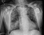 Chest radiograph of a patient (patient 7) showing right upper lobe opacification in study of acute Q fever infections in the intensive care unit in tropical Australia, 2015–2023. The patient required mechanical ventilation for 72 hours.