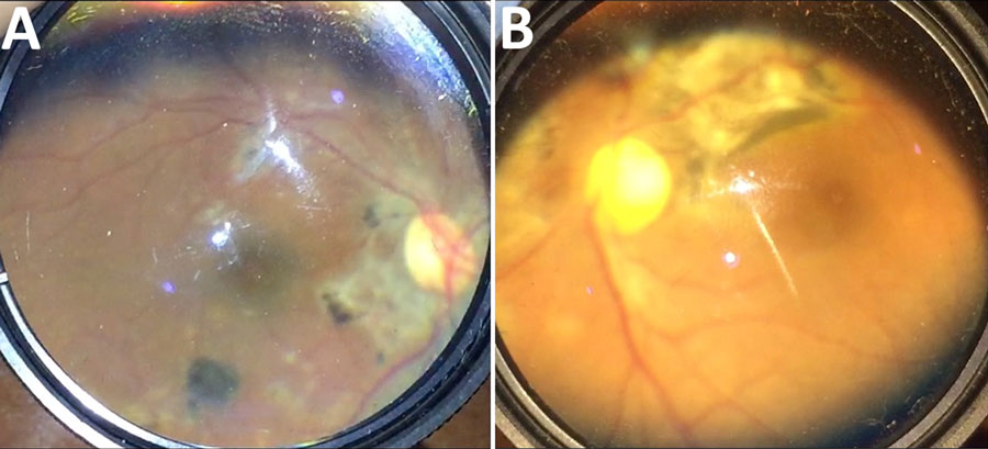 Posterior and fundus photographs showing the spectrum of ophthalmic sequelae associated with EVD in survivors, Sierra Leone. A) Posterior segment photograph of an EVD survivor shows peripapillary chorioretinal scarring and variable pigmentary changes indicative of multifocal choroiditis. B) Fundus photograph of another survivor shows dense chorioretinal scarring along the superotemporal arcade and nasal to the nerve, consistent with inactive posterior uveitis. EVD, Ebola virus disease.