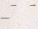 Warthin-Starry staining of aortic valve vegetation from a person experiencing homelessness who had Bartonella quintana endocarditis, New York, New York, USA. The presence of argyrophilic microorganisms is consistent with Bartonella (arrow). Original magnification ×500.