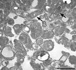 Transmission electron microscopy image from a person experiencing homelessness who had Bartonella quintana endocarditis, New York, New York, USA. Image reveals pleomorphic bacteria from a formalin-fixed paraffin-embedded tissue section. Arrows indicate 2 rod-shaped bacteria present in the aorta of the patient. Scale bar indicates 2 μm.