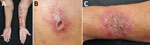 Clinical disease manifestations in study of antifungal drug susceptibility and treatment outcomes for emerging zoonotic cutaneous sporotrichosis, Thailand. A) Lymphocutaneous pattern on a patient’s left forearm; B) satellite nodules encircling ulcer rim on a patient’s left cheek; C) verrucous plaque on a patient’s left forearm.