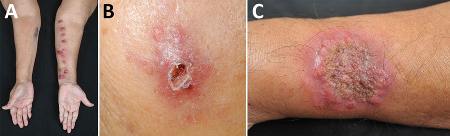 Clinical disease manifestations in study of antifungal drug susceptibility and treatment outcomes for emerging zoonotic cutaneous sporotrichosis, Thailand. A) Lymphocutaneous pattern on a patient’s left forearm; B) satellite nodules encircling ulcer rim on a patient’s left cheek; C) verrucous plaque on a patient’s left forearm.