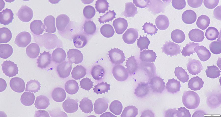 Babesia venatorum parasites in blood of patient with autochthonous human babesiosis, the Netherlands. Giemsa-stained thin smear from blood of patient before start of treatment and visualized with light microscopy (original magnification ×1,250) shows small and pleomorphic amoeboid and vacuolar asexual stages of Babesia spp., positioned within and outside red blood cells, which is typically observed in human babesiosis. Of note, 1 dark blue–stained Howell-Jolly body is observed.