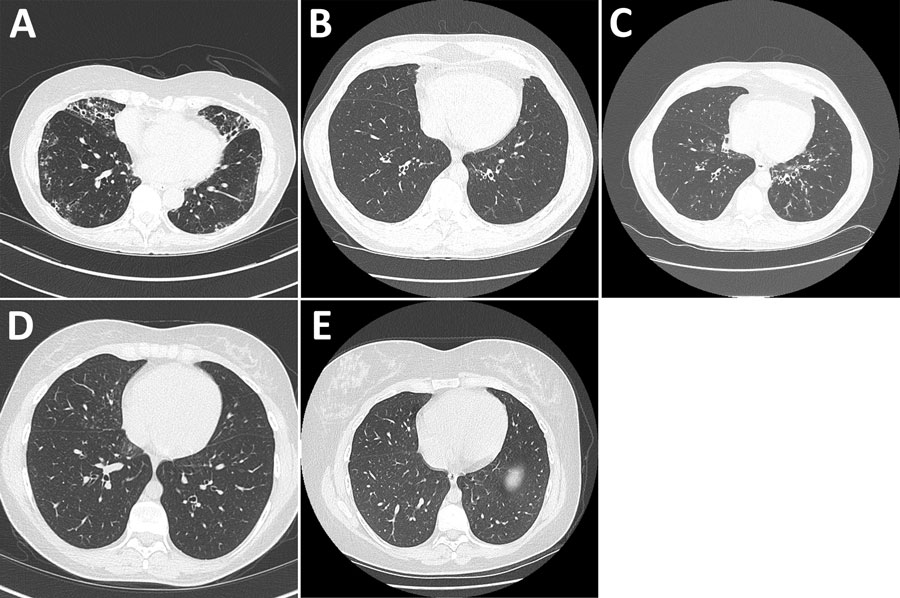 High-resolution chest computed tomography scans from study of Mycobacterium nebraskense isolated from patients in Connecticut and Oregon, USA. A) Scan from case 2 in Connecticut showing bronchiectasis in the right middle and lower lobe, left lower lobe, and lingula and tree-in-bud nodularity in the lingula and right and left lower lobes of the lung. B) Scan slice from case 3 in Connecticut through the lower lung lobes showing 1 borderline dilated airway in the left lower lobe, performed in May 2019. C) Scan slice from case 3 at the same anatomic level showing numerous dilated airways and airway wall thickening in the left lower lobe of lung, performed in April 2020 soon after the first isolation of M. nebraskense. D) Scan from case 4 in Connecticut showing tree-in-bud nodularity in the right middle and lower lobes of the lung when patient had M. nebraskense isolated from her sputum in August 2020. E) Scan from case 4 in Connecticut showing resolution of the tree-in-bud nodularity in the right middle and lower lobes of the lung, performed in December 2022.