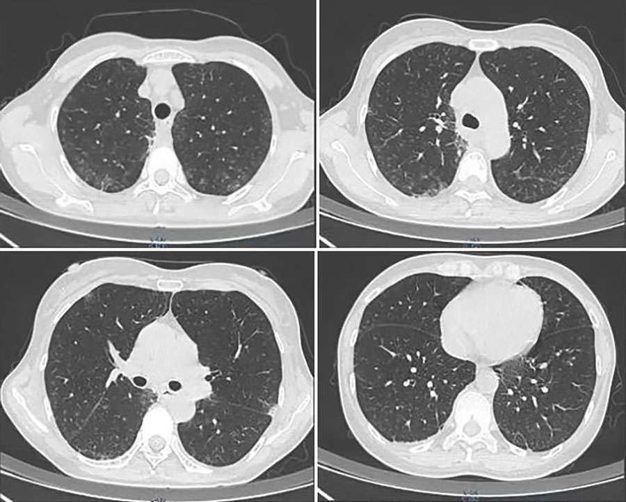 Figure 1 - Non-HIV Immunocompetent Patient with COVID-19 and Severe ...