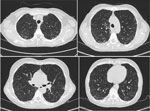 Chest computed tomography scans of immunocompetent patient in China who was co-infected with COVID-19 and non-HIV severe Pneumocystis jirovecii pneumonia, performed on June 25, 2023. Images show multiple tree-in-bud signs, ground-glass shadows, and substantially increased bilateral subpleural consolidation in the lungs.