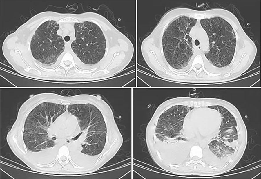 Figure 3 - Non-HIV Immunocompetent Patient with COVID-19 and Severe ...