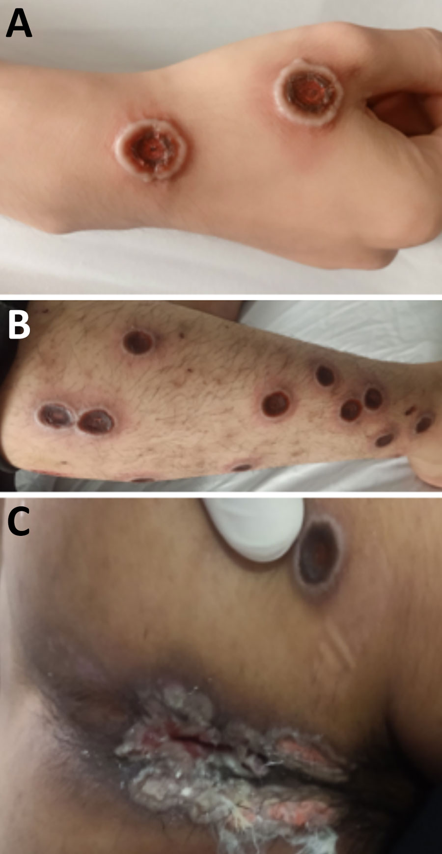 Natural progression of skin lesions of mpox patient who died in study of emerging monkeypox virus sublineage C.1 causing community transmission, Vietnam, 2023. Skin lesions shown are on the right hand (A), right leg (B), and perianal and buttock areas (C) of a patient with a CD4 cell count of 16 cells/µL.