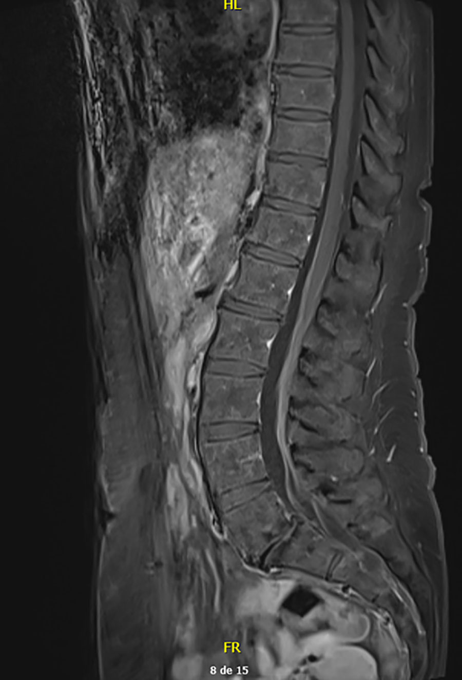 Contrast-enhanced T1-weighted magnetic resonance imaging scans of spine and cauda equina in study of Borrelia spielmanii–associated neuroborreliosis in patient receiving rituximab, Belgium. Subtle intradural contrast enhancement was noted after gadolinium injection. No hypertrophy of the cauda equina was found. 