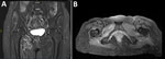 Coronal (A) and axial (B) T1 short-tau inversion recovery magnetic resonance imaging sequences of the hip in study of Borrelia spielmanii–associated neuroborreliosis in patient receiving rituximab, Belgium. Hyperintense infiltration of the right adductor muscle compartment (and partially of the hamstrings) was noted. No enhancement was seen after gadolinium injection. 