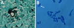 Autochthonous Blastomyces dermatitidis biopsy and culture findings from a patient in India. Microscopic characteristics are consistent with Blastomyces dermatitidis. A) Gomori’s methenamine silver–stained section of a subcutaneous nodule biopsy obtained from sternum region showing a large, thick-walled broad-based budding yeast cell (white arrows) typical of Blastomyces. B) Lactophenol cotton blue mount of the 6-day-old yeast form on pea seed agar at 37°C, showing numerous large thick-walled and broad-based budding yeast cells (white arrow). Original magnification is ×100.