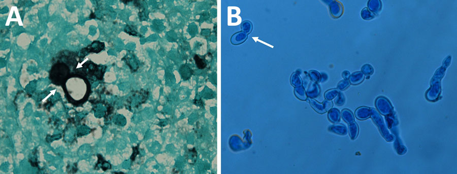 Autochthonous Blastomyces dermatitidis biopsy and culture findings from a patient in India. Microscopic characteristics are consistent with Blastomyces dermatitidis. A) Gomori’s methenamine silver–stained section of a subcutaneous nodule biopsy obtained from sternum region showing a large, thick-walled broad-based budding yeast cell (white arrows) typical of Blastomyces. B) Lactophenol cotton blue mount of the 6-day-old yeast form on pea seed agar at 37°C, showing numerous large thick-walled and broad-based budding yeast cells (white arrow). Original magnification is ×100.