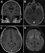 Brain magnetic resonance imaging scans from 2 patients with bunyavirus-associated meningoencephalitis, United States, 2020–2023. A, B) Case-patient 1 brain T1 postcontrast images of coronal (A) and axial (B) sections showing moderately enlarged ventricles and cerebral atrophy. C, D) Case-patient 2 brain T1 postcontrast (C) and T2 postcontrast fluid attenuated inversion recovery (D) images demonstrating bilateral basal ganglia hyperintensities with no contrast enhancement.