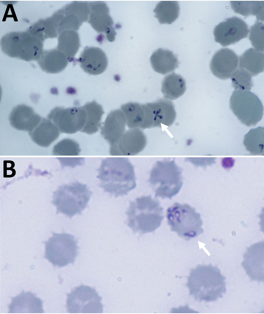 Giemsa-stained thin blood film from a case of autochthonous human Babesia divergens infection, England. A) Stains show characteristic Maltese cross form (arrow) and erythrocytes containing 5 pyriform rings. Original magnification ×1,000. B) Absence of pigment in erythrocytes (arrow). Original magnification ×1,000.