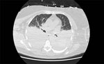 Axial computed tomography image from a case of autochthonous human Babesia divergens infection, England. Image shows bilateral pleural effusions. 