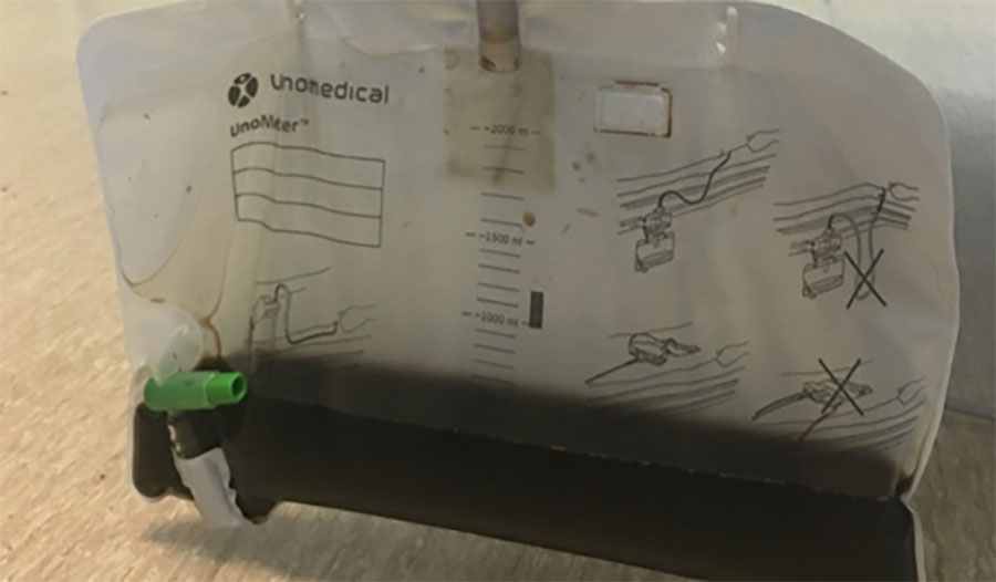 Urometer from a case of autochthonous human Babesia divergens infection, England. Black urine can be noted in the collection bag.