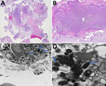 Imaging of samples from patient in study of infection by tickborne bacterium Candidatus Midichloria associated with first trimester pregnancy loss, Tennessee, USA. A, B) Formalin-fixed paraffin-embedded sections showing acute suppurative villitis and large intravillous abscesses. Original magnification ×40 for panel A and ×200 for panel B. C, D) Electron microscopy analysis was performed on tissue that was previously formalin-fixed but not paraffin-embedded. The formalin-fixed tissue was placed in a 2.5% glutaraldehyde solution before electron microscopy analysis. C) Intracellular bacterial forms in the cytosol (indicated by arrows) at ×20,000 magnification; D) cytoplasmic vacuoles (indicated by arrows) at ×60,000 magnification, measuring ≈0.25–0.34 μm × 0.40–0.53 μm.