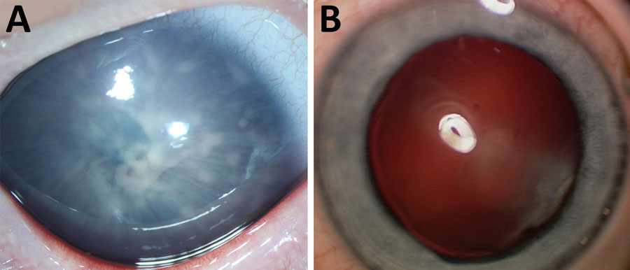 Spectrum of Spiroplasma spp.–caused eye disease documented in a multicenter retrospective study of Spiroplasma ixodetis infantile cataract in 8 countries in Europe. The study included a total of 18 children and 28 eyes. A) Preoperative image of patient 15, showing extensive endothelial precipitates and cataract and iris vascularization extending to the lens. B) Mild cataract in the left eye of patient 9 without apparent uveitis.