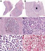 Photomicrography of tissues from study of multisystemic disease and septicemia caused by presumptive Burkholderia pseudomallei in American quarter horse, Florida, USA. Photomicrographs show hematoxylin and eosin staining of submandibular lymph node (LN) (A, C, E) and lung (B, D) and Gram stain of the submandibular LN (F). A) Submandibular LN shows multifocal to coalescing pyogranulomas. Original magnification ×2. B) The lung contains a parabronchial abscess (star). Original magnification ×2. C) The submandibular LN pyogranuloma contains necrotic debris, suppurative inflammation, and numerous hemosiderin laden macrophages, multinucleated giant cells surrounded by fibrosis. Original magnification ×20. D) Macrophages and neutrophils in the pulmonary abscess contain a mixed population of 1–2 μm coccobacilli. Original magnification ×40. E) The submandibular node neutrophils and macrophages contain numerous intracellular 1–2 μm bacilli (red arrows). Original magnification ×40. F) The bacilli in the submandibular lymph node are diffusely gram-negative (black arrows). Original magnification ×30.
