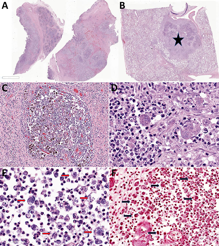 Photomicrography of tissues from study of multisystemic disease and septicemia caused by presumptive Burkholderia pseudomallei in American quarter horse, Florida, USA. Photomicrographs show hematoxylin and eosin staining of submandibular lymph node (LN) (A, C, E) and lung (B, D) and Gram stain of the submandibular LN (F). A) Submandibular LN shows multifocal to coalescing pyogranulomas. Original magnification ×2. B) The lung contains a parabronchial abscess (star). Original magnification ×2. C) The submandibular LN pyogranuloma contains necrotic debris, suppurative inflammation, and numerous hemosiderin laden macrophages, multinucleated giant cells surrounded by fibrosis. Original magnification ×20. D) Macrophages and neutrophils in the pulmonary abscess contain a mixed population of 1–2 μm coccobacilli. Original magnification ×40. E) The submandibular node neutrophils and macrophages contain numerous intracellular 1–2 μm bacilli (red arrows). Original magnification ×40. F) The bacilli in the submandibular lymph node are diffusely gram-negative (black arrows). Original magnification ×30.