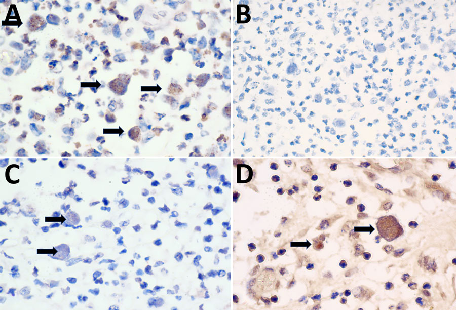 Immunohistochemical examination of tissues from American quarter horse with multisystemic disease and septicemia caused by presumptive Burkholderia pseudomallei, Florida, USA. Photomicrographs show immunohistochemistry for monoclonal antibodies 3A2 (A), 4C7 (B), 4C4 (C), and 5B4 (D) of the submandibular lymph node. A) Intra-phagocytic bacilli demonstrated strong immunoreactivity to 3A2 monoclonal antibody to B. pseudomallei lipopolysaccharides (LPS) O-Ag B/B2 (black arrows). Original magnification ×100. B) Intra-phagocytic bacilli were diffusely immunonegative for 4C7 monoclonal antibody to B. pseudomallei LPS O-ag serotype A. Original magnification ×40. C) Intra-phagocytic bacilli demonstrated weak multifocal immunoreactivity to 4C4 monoclonal antibody to B. pseudomallei capsular polysaccharides (black arrows). Original magnification ×100. D) Intra-phagocytic bacilli demonstrated strong immunoreactivity to 5B4 monoclonal antibody to B. pseudomallei LPS O-Ag B/B2 (black arrows). Original magnification ×100. Bacilli were immunonegative to 3D11 (not shown) monoclonal antibody to Bm LPS O-Ag.