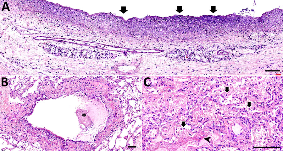 Hematoxylin and eosin–stained tissue samples from colobus 1 in an investigation of novel mastadenovirus infection causing pneumonia in imported black-and-white colobuses (Colobus guereza), Thailand. A) Trachea showing mucosa is extensively replaced by laminated bands of fibrillar material (arrows) intermixed with aggregates of karyorrhectic debris and degenerated neutrophils. B) Lung section showing lumen of the bronchial airways; flocculent mats of fibrin (asterisk) and neutrophils can be seen. C) Lung section showing alveoli filled with foamy macrophages (arrows), polymorphonuclear cells and eosinophilic material (arrowhead); alveolar capillaries are markedly engorged. Scale bars indicate 100 µm.