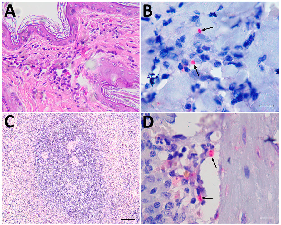 Figure 1. Histologic sections from autochthonous Leishmania (Viannia) lainsoni in dog (Canis familiaris), Rio de Janeiro state, Brazil, 2023. A, B) Skin of the examined dog: hyperkeratosis and moderate granulomatous infiltrate in the dermis are composed mainly of macrophages, with a smaller number of plasma cells and lymphocytes (A) and red-stained amastigotes in the cytoplasm of macrophages (arrows) (B). C, D) Spleen of the examined dog: lymphoid hyperplasia (C) and red-stained amastigotes in the cytoplasm of macrophages in the parenchyma (arrows) (D). A, C) Hematoxylin-eosin stain; B, D) immunohistochemistry. Scale bars indicate 10 µm. Histologic sections from autochthonous Leishmania (Viannia) lainsoni in dog (Canis familiaris), Rio de Janeiro state, Brazil, 2023. A, B) Skin of the examined dog: hyperkeratosis and moderate granulomatous infiltrate in the dermis are composed mainly of macrophages, with a smaller number of plasma cells and lymphocytes (A) and red-stained amastigotes in the cytoplasm of macrophages (arrows) (B). C, D) Spleen of the examined dog: lymphoid hyperplasia (C) and red-stained amastigotes in the cytoplasm of macrophages in the parenchyma (arrows) (D). A, C) Hematoxylin-eosin stain; B, D) immunohistochemistry. Scale bars indicate 10 µm.