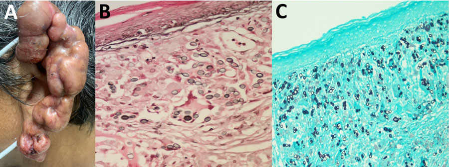 Clinical manifestations of lesions in patient with lobomycosis in Amazon Region, Bolivia, 2022. A) Multiple hyperpigmented, confluent keloid-like nodular lesions with overriding telangiectasias and patchy crusted and eroded squamous areas were noted on the helix and lobule of the left ear. B, C) Histologic examination of lesion specimens showed oval-to-round shaped cells that had connecting tubular projections organized in a string-of-pearls pattern, in pairs and individually. B) Fontana-Masson stain; original magnification ×1,000. C) Gömöri methenamine silver stain; original magnification ×400.