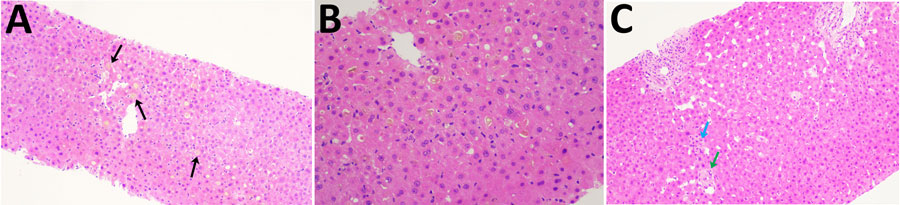 Hematoxylin and eosin stained liver sections of patients in study of human circovirus in patients with hepatitis, Hong Kong. A, B) Cholestasis with bile pigment in zone 3 canaliculi (arrows) in patient 5 at original magnification ×10 (A) and original magnification ×20 (B). C) Acidophil body (blue arrow) with neutrophils around ducts (green arrow) in patient 8; original magnification ×10. 