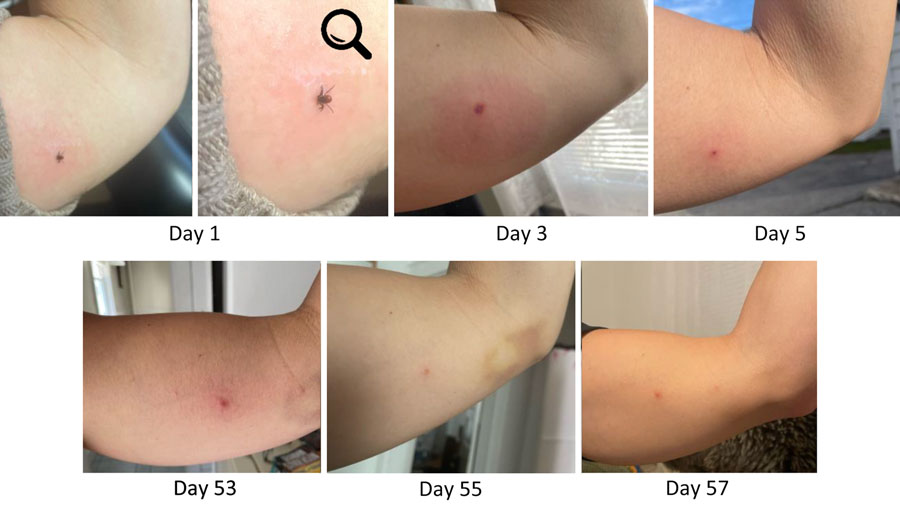 Progression and persistence of bite site reaction in alpha-gal syndrome after Ixodes scapularis tick bite, Maine, USA, 2022. A) Day 1, attached Ixodes scapularis adult female; B) enlarged version of image in panel A; magnification ×2.1; C) day 3, growing erythema surrounding tick bite site accompanied by intense and increasing pruritus; D) day 5, bite site less inflamed and with scab; E) day 53, patient resumed photo documentation because of persistent pruritus and “flares” of lesion becoming intermittently raised; F) day 55, lesion improved; G) day 57, lesion slightly raised again, photo taken to document variation. After these photos, pruritus largely resolved. As of December 2024, the bite site remains identifiable as an asymptomatic papule.