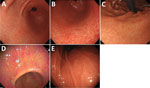 Representative endoscopic images of gastritis types observed in study of non–H. pylori Helicobacter infections, Japan, 2022. A) White marbled appearance. A white mesh pattern composed of shallow depressions that looks like white marble from the gastric antrum to the angle. White light imaging (WLI). B) Crack-like mucosa. A mesh pattern composed of faded and depressed lines with varied widths on coarse surfaces (WLI). C) Nodular gastritis. Compared with nodular gastritis caused by H. pylori infection, nodules that are shorter and appear as white spots are also considered nodular gastritis (WLI). D) Spotty redness, includes findings similar to those of H. pylori infection in the gastric body and the antrum (linked-color imaging). E) Regular arrangement of collecting venules. Microvessels with starfish-like appearance are observed as minute red points in the gastric lower body (WLI).