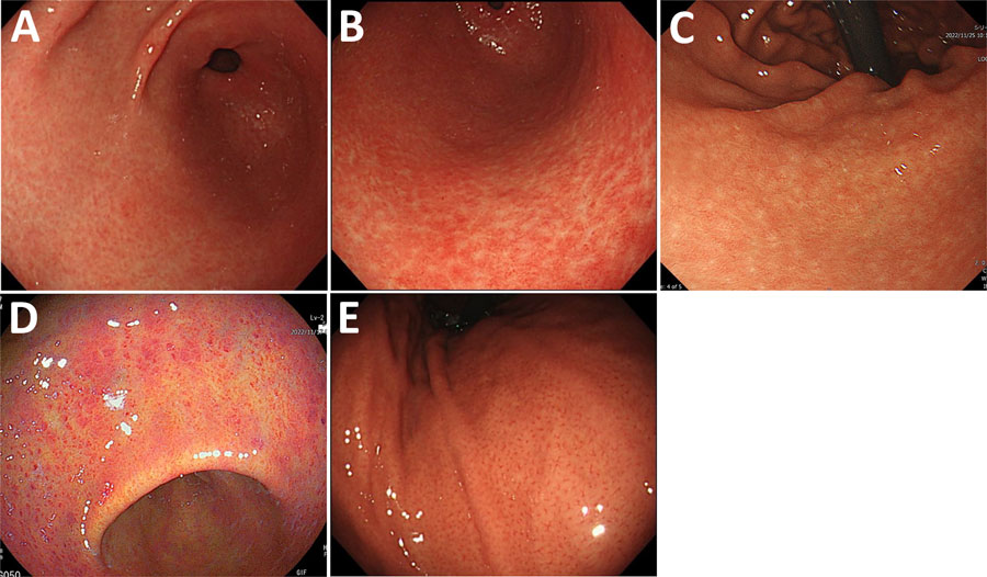 Representative endoscopic images of gastritis types observed in study of non–H. pylori Helicobacter infections, Japan, 2022. A) White marbled appearance. A white mesh pattern composed of shallow depressions that looks like white marble from the gastric antrum to the angle. White light imaging (WLI). B) Crack-like mucosa. A mesh pattern composed of faded and depressed lines with varied widths on coarse surfaces (WLI). C) Nodular gastritis. Compared with nodular gastritis caused by H. pylori infection, nodules that are shorter and appear as white spots are also considered nodular gastritis (WLI). D) Spotty redness, includes findings similar to those of H. pylori infection in the gastric body and the antrum (linked-color imaging). E) Regular arrangement of collecting venules. Microvessels with starfish-like appearance are observed as minute red points in the gastric lower body (WLI).