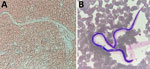 Microphotographs of microfilaria from a sample collected in Futuna, June 2024. A) Fresh blood smear from an antigen-positive child’s close contact; original magnification ×40. B) Smear after May-Grunwald-Giemsa staining; original magnification ×100).