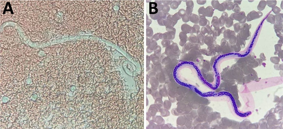 Microphotographs of microfilaria from a sample collected in Futuna, June 2024. A) Fresh blood smear from an antigen-positive child’s close contact; original magnification ×40. B) Smear after May-Grunwald-Giemsa staining; original magnification ×100).