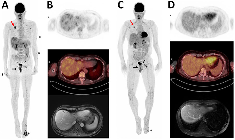 Positron emission tomography/computed tomography (PET/CT) scans and magnetic resonance imaging (MRI) of HIV/hepatitis B virus co-infected patient in case study of mpox hepatic and pulmonary lesions, France. A) Whole-body 18F-fluorodeoxyglucose (18F-FDG) PET/CT 3-dimensional maximum intensity projection performed in December 2022. Asterisks indicate anterior view of skin lesions. Black arrow indicates lesions in lower rectum; maximum standard uptake value (SUVmax) = 7. Red arrow indicates tumor in upper right lung; SUVmax = 6.4. Heterogeneous hepatic metabolism and multiple small foci of uptake were observed on liver transaxial views, which showed more intense metabolic ranges in the subcapsular region (SUVmax = 3.6). A hypermetabolic contralateral apical pulmonary nodule (SUVmax = 2.7) was also observed but is not visible in this image. B) Upper image shows liver transaxial 18F-FDG PET, middle image is fused PET/CT, and lower image is liver MRI (axial liver acceleration volume acquisition). C) Follow-up whole-body 18F-FDG PET/CT 3-dimensional maximum intensity projection performed in January 2023. Anterior view indicates substantial decreases in metabolic uptake intensities in foot lesion (asterisk), rectum (black arrow), and right lung tumor (red arrow). Tumor was 36 mm versus 46 mm in December, SUVmax 3.9 versus 6.4. Decrease in left apical pulmonary nodule, 9 mm versus 11 mm, SUVmax 1.3 versus 2.7; nodule was not visible in this image. D) Follow-up images indicate substantial decrease of liver abscesses. Upper image shows liver transaxial 18F-FDG PET, middle image is fused PET/CT, and lower image is liver MRI (axial T1 fat suppression volumetric interpolated breath-hold examination portal).