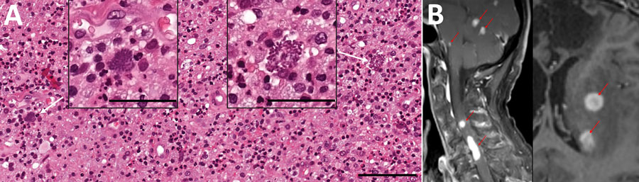 Microscopic findings and imaging results for patient with HIV-induced immunodeficiency preceding diagnosis of neurosarcocystosis, Norway. A) Light microscopic findings of structures resembling Toxoplasma gondii bradozoites (white arrows) in brain biopsy. Hematoxylin and eosin stain. Scale bars of enlarged images indicate 50 μm; scale bar of background image indicates 100 μm. B) Magnetic resonance imaging of cerebral and spinal cord lesions (contrast enhanced sagtittal T1 sequence, left panel, red arrows) and cerebral lesions with slight peripheral ring enhancement (contrast enhanced transversal T1 sequence, right panel, red arrows). 