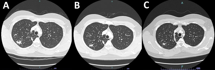 Computed tomography (CT) scans for reported case of Tsukamurella tyrosinosolvens infection in 25-year-old immunocompetent man. A) Initial CT showing 25-mm cavitating right apical lesion. B) Repeat CT after 6 months of treatment, indicating interval cavitary lesion reduction to 10 mm and resolution of the second smaller cavitation seen on original CT. C) Final CT 6 months after treatment cessation, indicating further cavity resolution without evidence of infection recurrence.