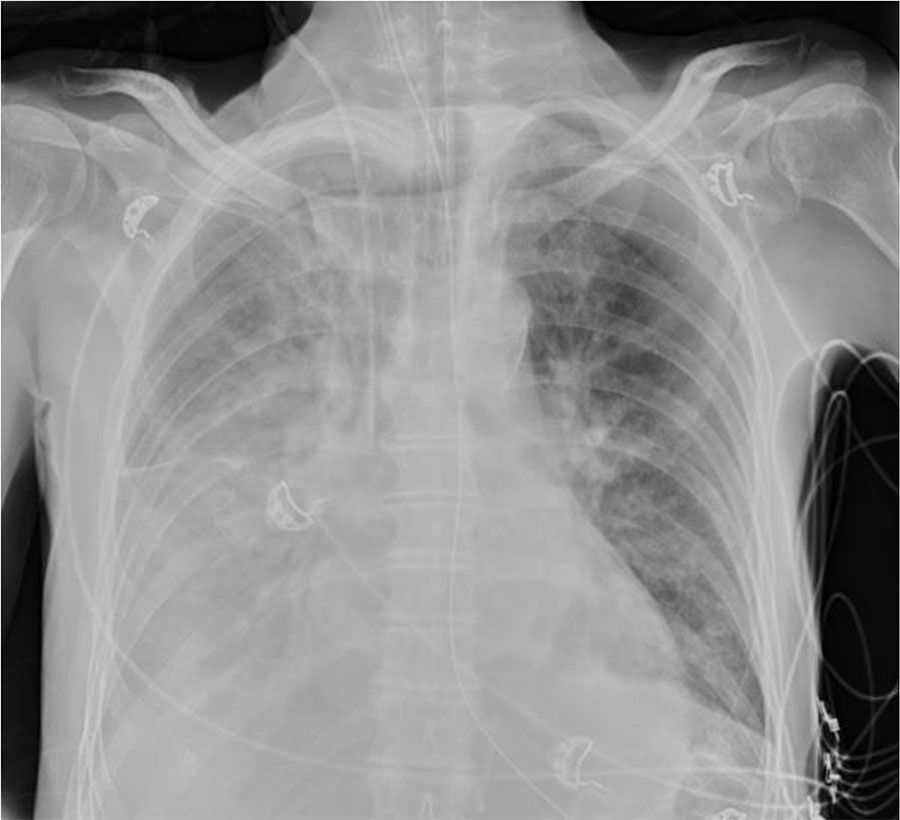 Chest radiograph of a patient with community-acquired pneumonia caused by avian Chlamydia abortus, the Netherlands. The radiograph shows progressive pulmonary consolidations with pleural effusion.