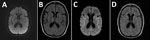 Magnetic resonance imaging of the brain from a case of cadaveric human growth hormone–associated Creutzfeldt-Jakob disease with long latency period, United States. A, B) Images obtained at initial clinical examination were unremarkable. C, D) Images obtained 3 months later demonstrated subtle areas of symmetric T2 hyperintensity in the insulae and frontotemporal lobes (C) and deep gray structures with diffusion restriction along the bilateral insulae and caudate heads without gadolinium enhancement (D).