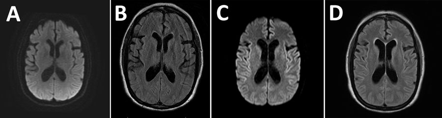 Magnetic resonance imaging of the brain from a case of cadaveric human growth hormone–associated Creutzfeldt-Jakob disease with long latency period, United States. A, B) Images obtained at initial clinical examination were unremarkable. C, D) Images obtained 3 months later demonstrated subtle areas of symmetric T2 hyperintensity in the insulae and frontotemporal lobes (C) and deep gray structures with diffusion restriction along the bilateral insulae and caudate heads without gadolinium enhancement (D).