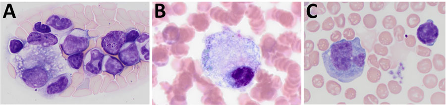 Whole blood smears depicting foamy macrophages in study of Peromyscus species deer mice as rodent model of acute leptospirosis. Representative blood smears containing foamy macrophages mice experimentally infected with Leptospira borgpetersenii strain LR131 (A), L. interrogans strain LAD1 (B), and noninfected control monocyte (C) are shown. Original magnification ×100.